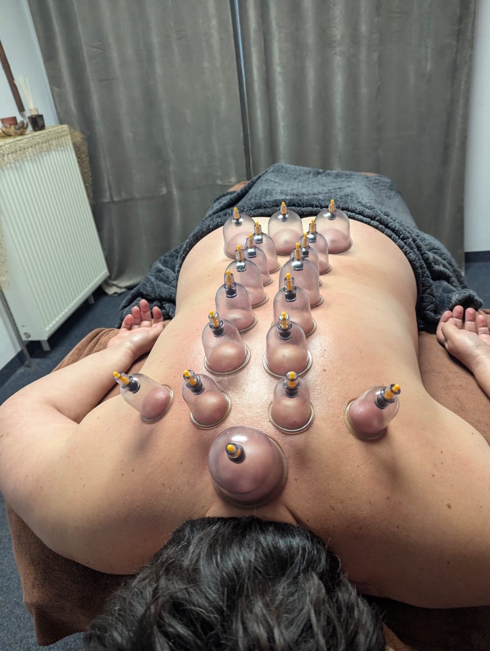Schröpftherapie Rücken